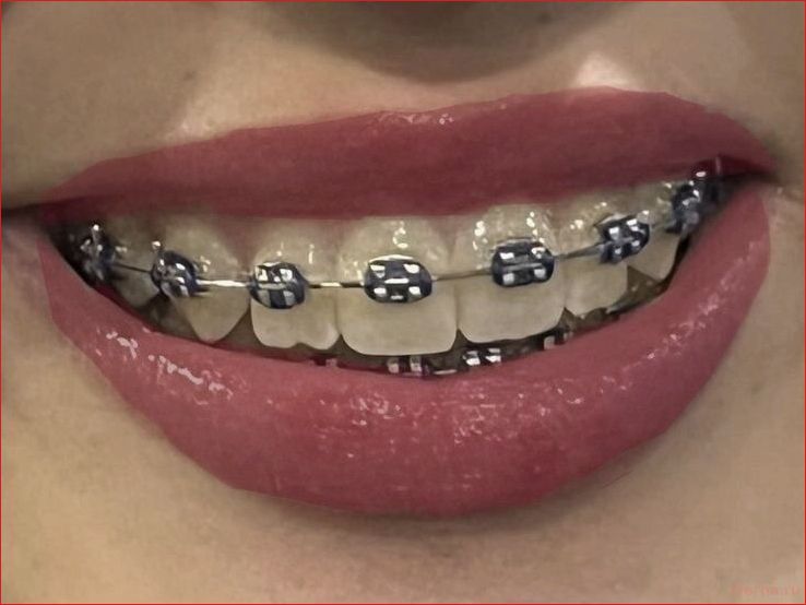 Элайнеры или брекеты: честное сравнение методов в 2026 году